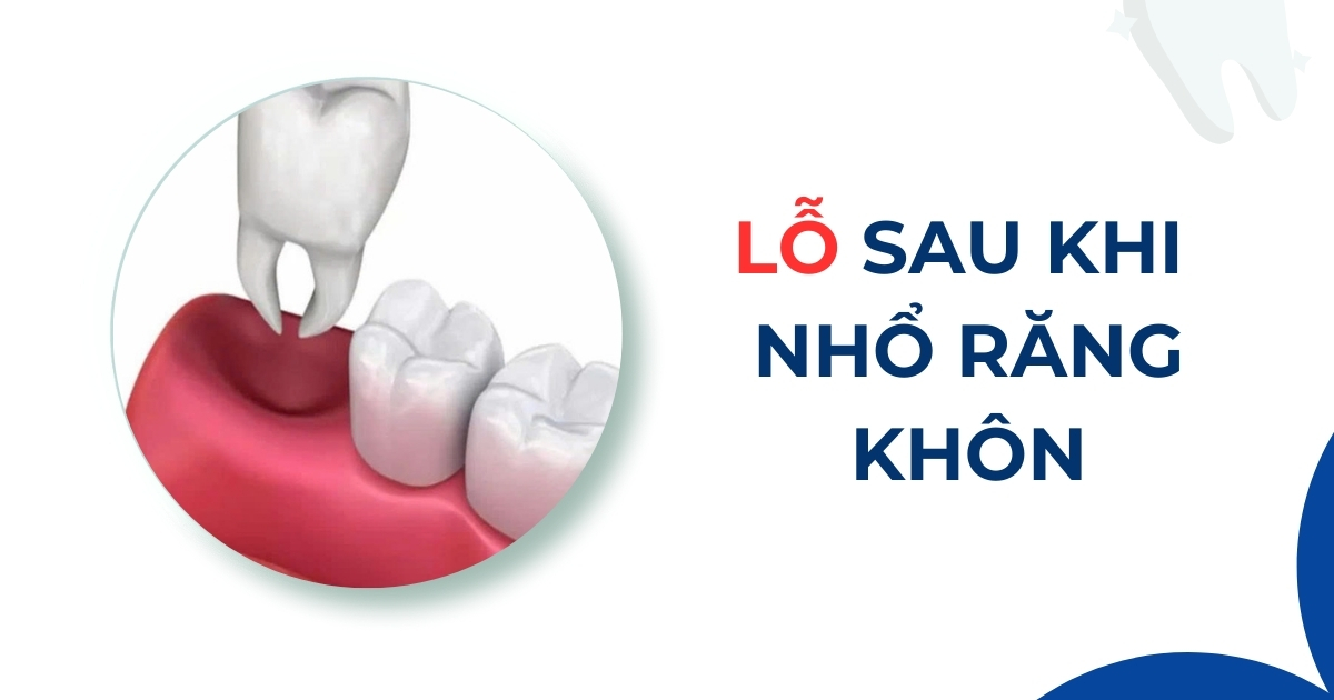 Lỗ sau khi nhổ răng khôn có sao không? Bao lâu thì lành?