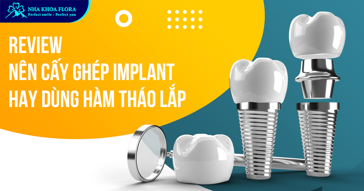 [Hỏi đáp]: Nên cấy ghép Implant hay dùng hàm tháo lắp?