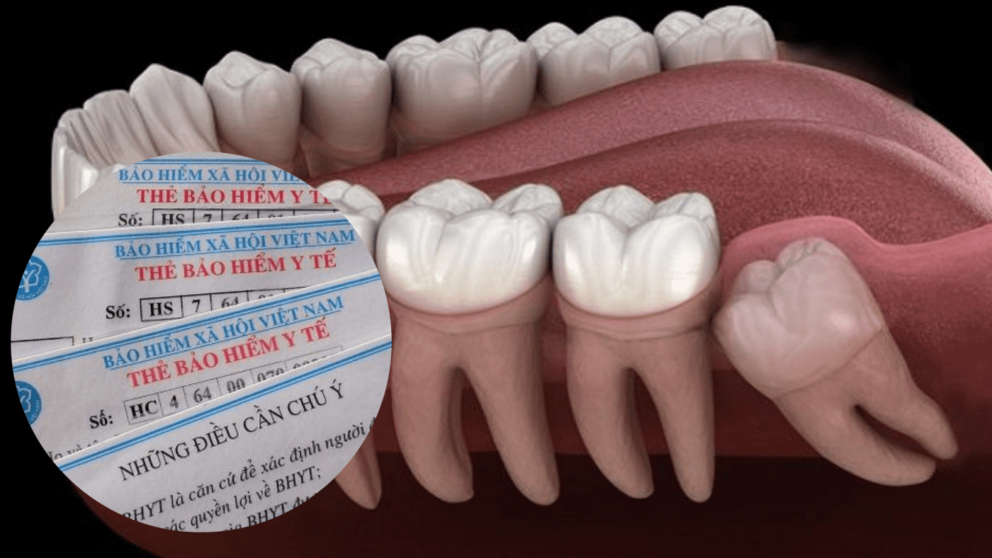 Nhổ răng khôn có được bảo hiểm y tế chi trả không? (ảnh minh họa) Nhổ răng khôn có được bảo hiểm y tế chi trả không? (ảnh minh họa)