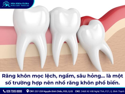 nhổ răng khôn kiêng gì - ảnh 1