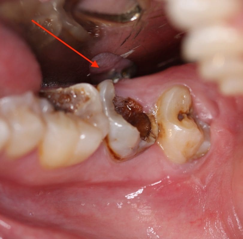 Răng khôn bị sâu lây lan sang các răng khác (ảnh minh họa)