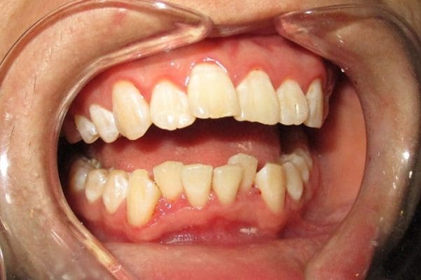 Răng mọc xô lệch (ảnh minh họa) Răng mọc xô lệch (ảnh minh họa)