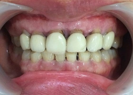 Răng sứ giá rẻ (ảnh minh họa) Răng sứ giá rẻ (ảnh minh họa)