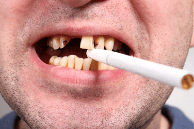 tác hại của thuốc lá với trồng răng Implant
