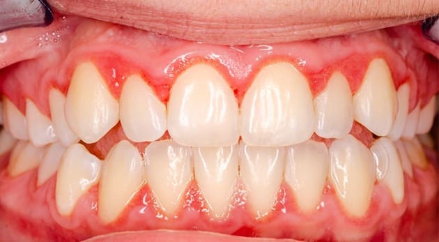 Viêm lợi sau khi bọc răng sứ do còn sót xi măng phục hình (ảnh minh họa) Viêm lợi sau khi bọc răng sứ do còn sót xi măng phục hình (ảnh minh họa)