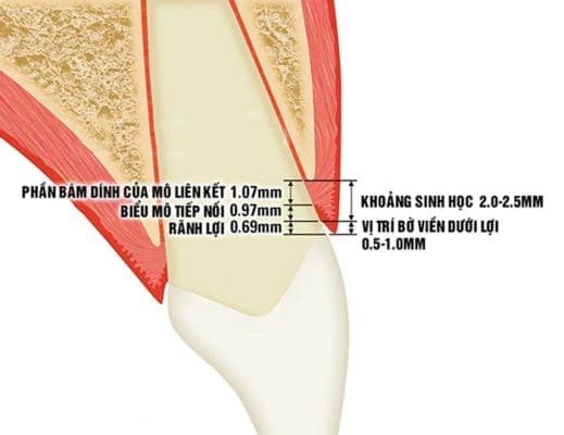 Viêm lợi sau khi bọc răng sứ do vi phạm khoảng sinh học (ảnh minh họa) Viêm lợi sau khi bọc răng sứ do vi phạm khoảng sinh học (ảnh minh họa)