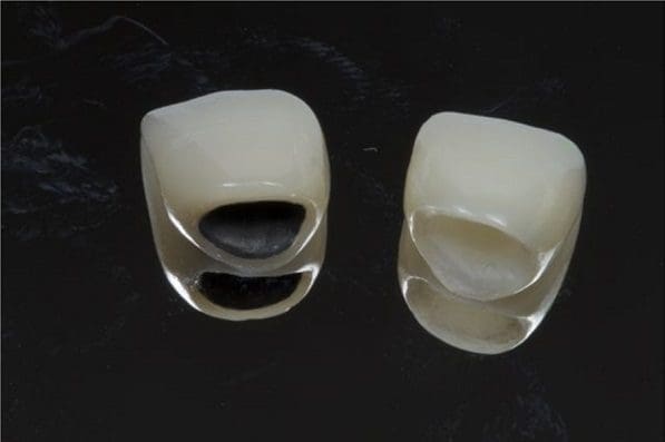 Bọc răng sứ bị hôi miệng do chất liệu răng sứ (ảnh minh họa)