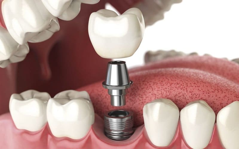 Trồng răng Implant được xem là phương pháp thay thế răng mất tiên tiến và tốt nhất Trồng răng Implant được xem là phương pháp thay thế răng mất tiên tiến và tốt nhất