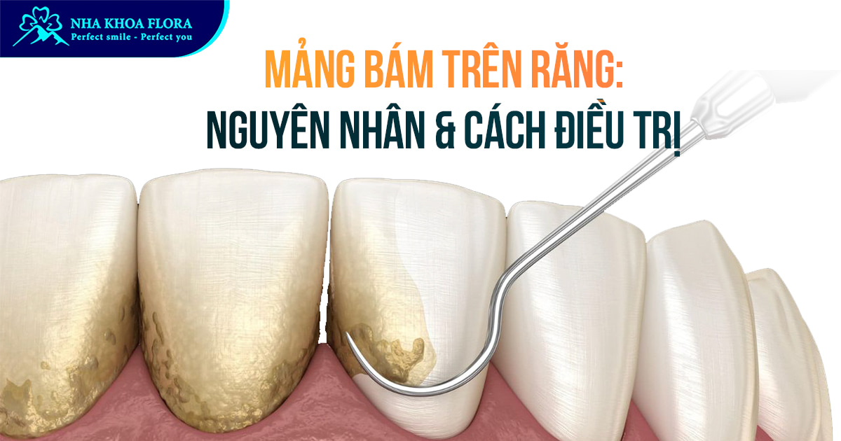 Mảng bám trên răng: Nguyên nhân Và Cách điều trị hiệu quả