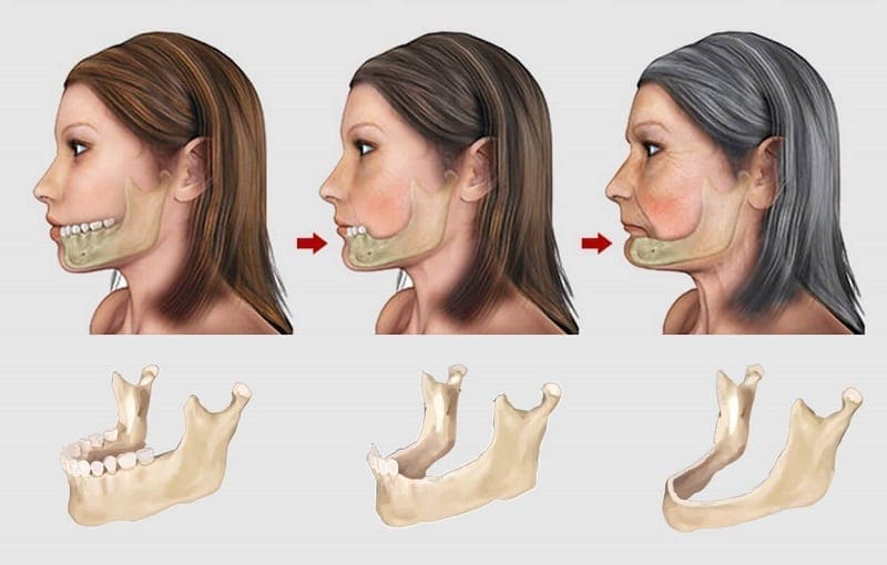 Mất răng gây ra tình trạng lão hóa sớm (ảnh minh họa) Mất răng gây ra tình trạng lão hóa sớm (ảnh minh họa)