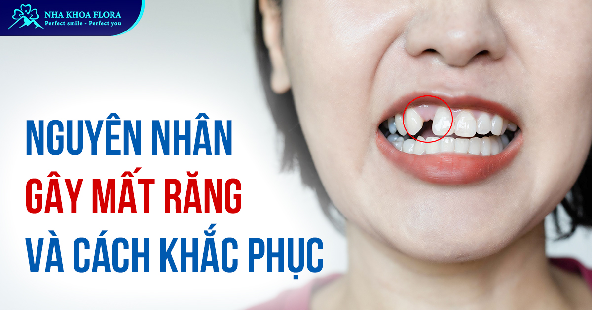 Nguyên nhân gây mất răng và cách khắc phục hiệu quả