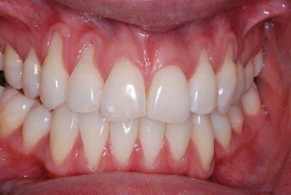 Răng sứ bị tụt lợi (ảnh minh họa) Răng sứ bị tụt lợi (ảnh minh họa)