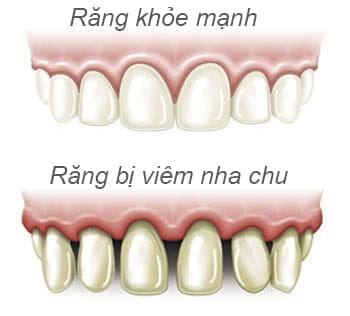 mang-bam-tren-rang mảng bám trên răng
