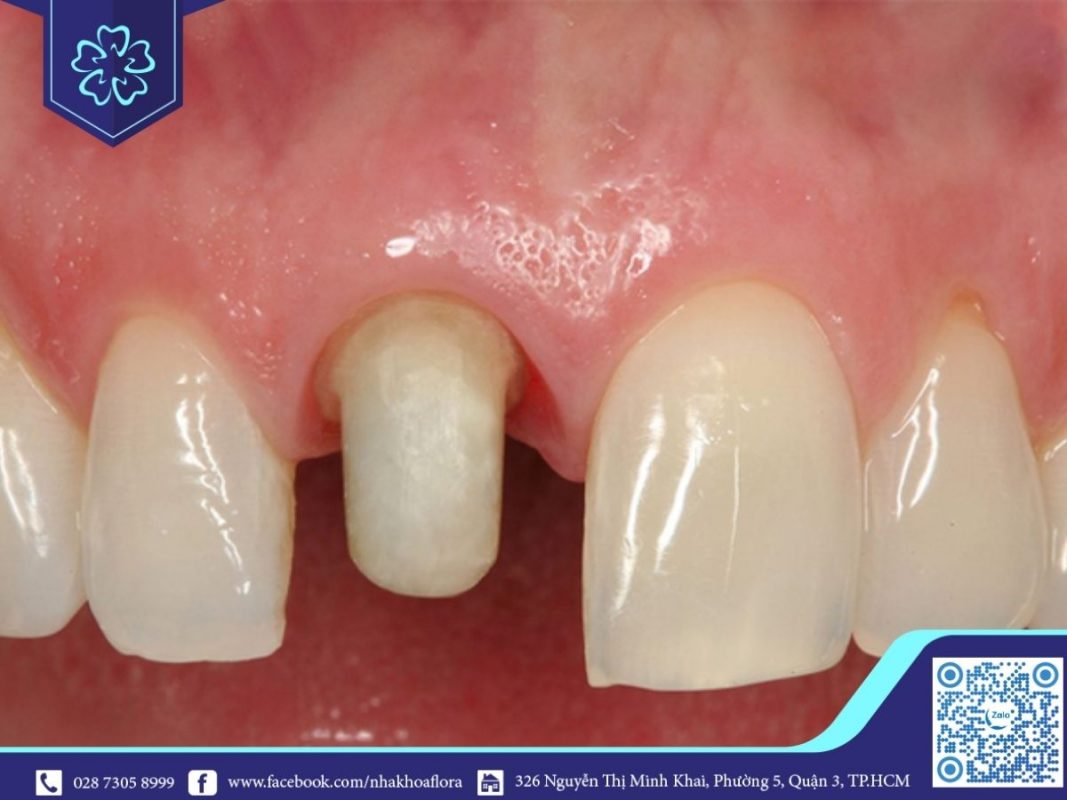 Bọc răng sứ khiến cấu trúc răng bị thay đổi (ảnh minh họa) Bọc răng sứ khiến cấu trúc răng bị thay đổi (ảnh minh họa)