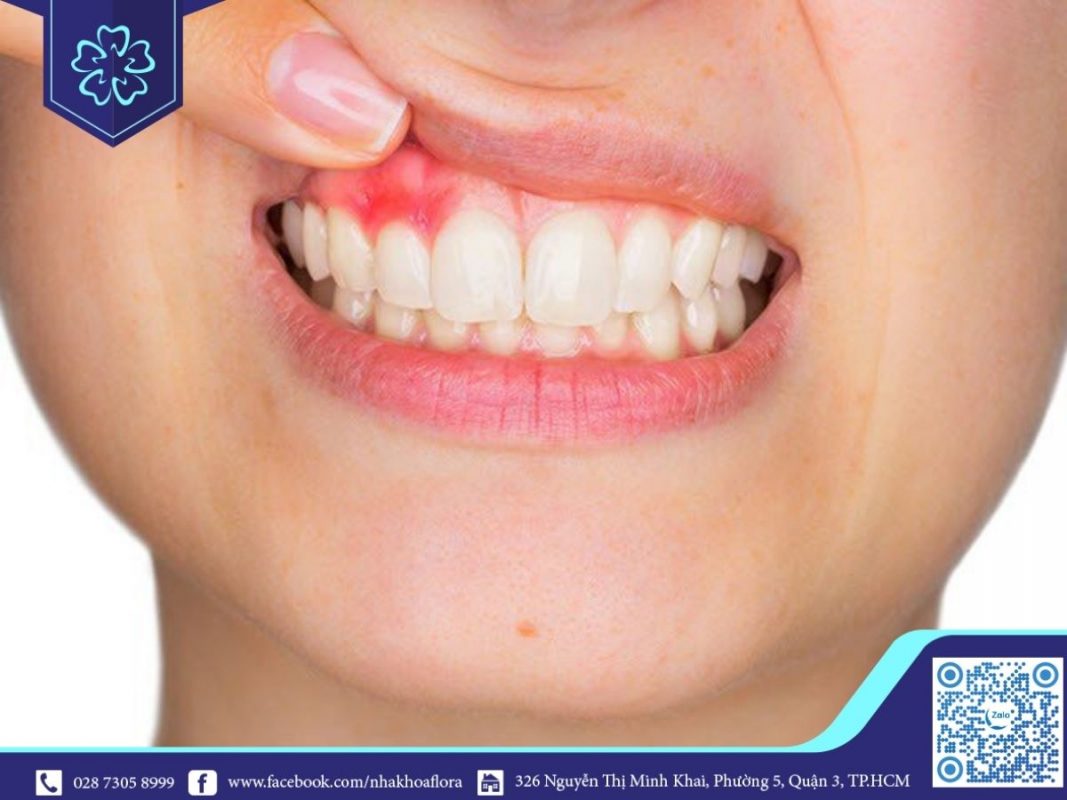 Làm răng sứ có nguy cơ xuất hiện viêm lợi, gây đau nhức (ảnh minh họa) Làm răng sứ có nguy cơ xuất hiện viêm lợi, gây đau nhức (ảnh minh họa)