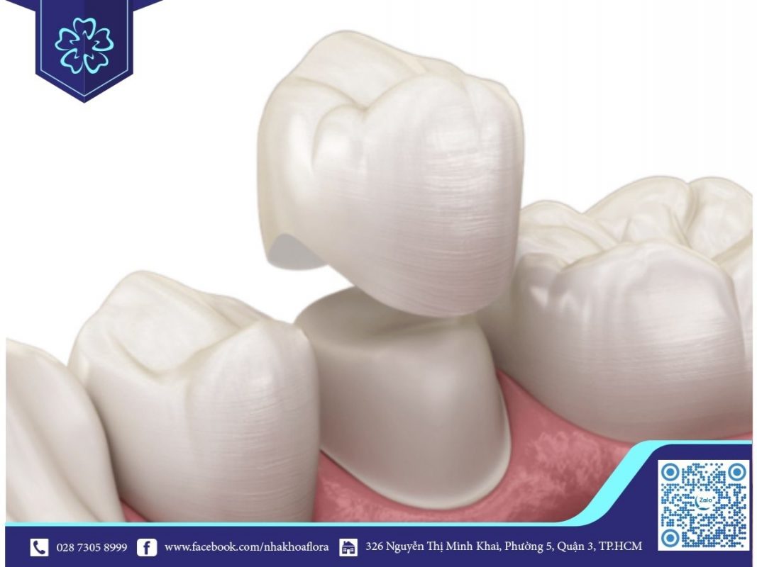 Bộc răng sứ bị cộm khiến bạn cảm thấy đau nhức (ảnh minh họa) Bộc răng sứ bị cộm khiến bạn cảm thấy đau nhức (ảnh minh họa)