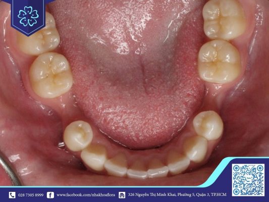 Tiêu xương theo chiều dọc (ảnh minh họa) Tiêu xương theo chiều dọc (ảnh minh họa)