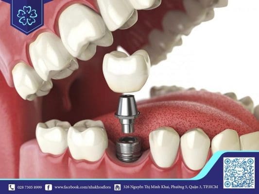 Trồng răng Implant khắc phục hoàn toàn tình trạng tiêu xương, xóa tan nổi lo mất răng bao lâu thì tiêu xương hàm (ảnh minh họa) Trồng răng Implant khắc phục hoàn toàn tình trạng tiêu xương, xóa tan nổi lo mất răng bao lâu thì tiêu xương hàm (ảnh minh họa)