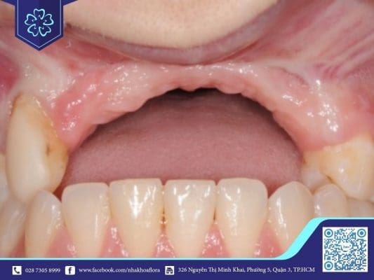 Mất răng bao lâu thì tiêu xương hàm? (ảnh minh họa) Mất răng bao lâu thì tiêu xương hàm? (ảnh minh họa)