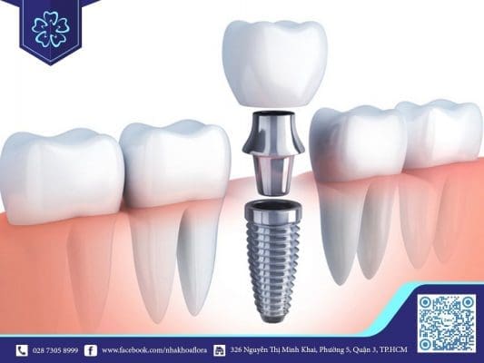 Mất răng hàm dưới có trồng răng Implant được không? (ảnh minh họa) Mất răng hàm dưới có trồng răng Implant được không