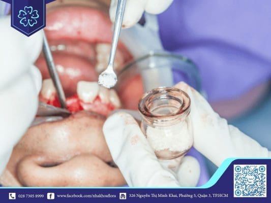 Ghép xương nhân tạo (ảnh minh họa) Ghép xương hàm răng nhân tạo