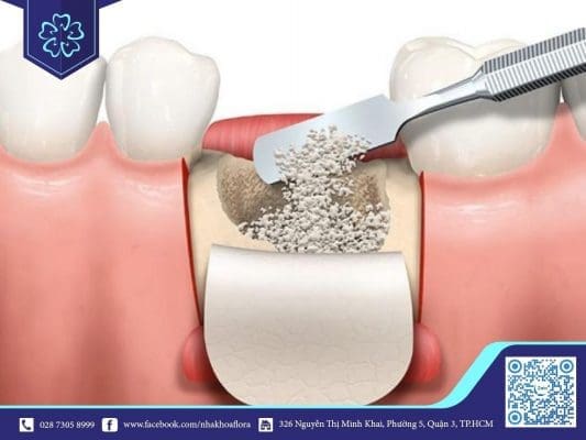 Ghép xương dị chủng (ảnh minh họa) Ghép xương dị chủng (ảnh minh họa)