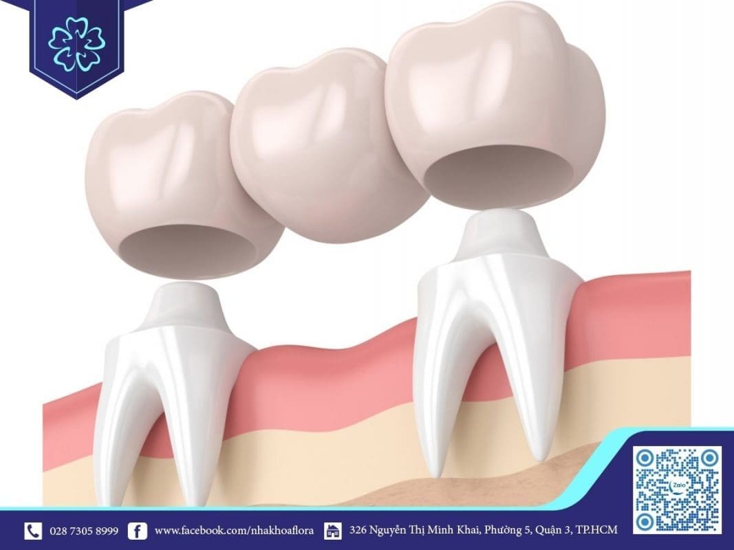 Mất răng số 6 có vẫn có thể niềng răng được và sau đó làm cầu răng sứ (ảnh minh họa) Mất răng số 6 có vẫn có thể niềng răng được và sau đó làm cầu răng sứ (ảnh minh họa)