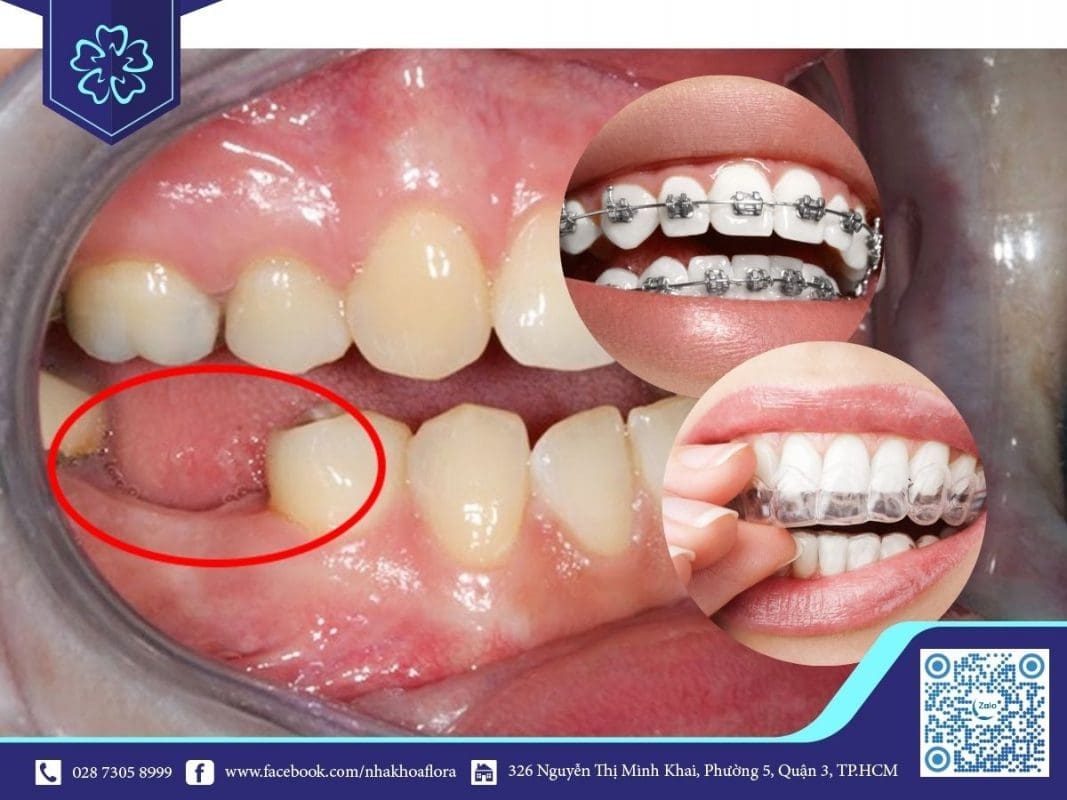 Mất răng số 6 có niềng răng được không? (ảnh minh họa) Mất răng số 6 có niềng răng được không? (ảnh minh họa)