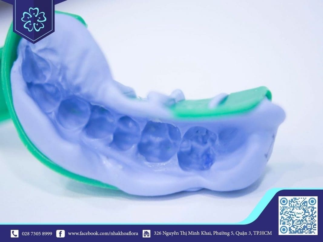 Lấy dấu để phục hồi cầu răng sứ cho răng số 6 (ảnh minh họa) Lấy dấu để phục hồi cầu răng sứ cho răng số 6 (ảnh minh họa)