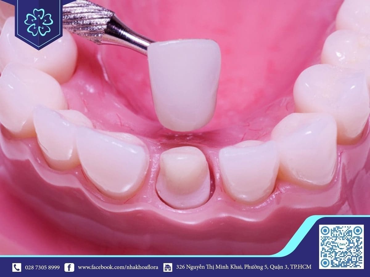 Bọc răng sứ 1 chiếc có được không? (ảnh minh họa) Bọc răng sứ 1 chiếc có được không? (ảnh minh họa)