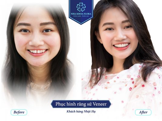 Khách hàng Nhật Hạ bọc răng sứ, thay đổi nụ cười tại nha khoa Flora (ảnh minh họa) Khách hàng Nhật Hạ bọc răng sứ, thay đổi nụ cười tại nha khoa Flora (ảnh minh họa)