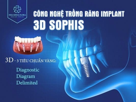 Công nghệ trồng răng Implant 3d Sophis tại nha khoa Flora Công nghệ trồng răng Implant 3d Sophis tại nha khoa Flora
