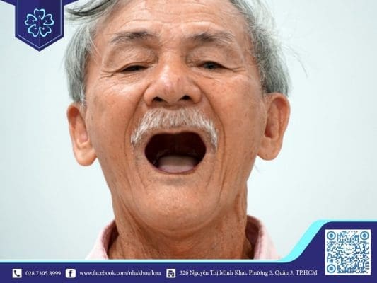 Ở độ tuổi này mất răng nhiều do đó cần phải lựa chọn địa chỉ nha khoa cấy ghép Implant uy tín cho người trung niên để đảm bảo an toàn (ảnh minh họa) Ở độ tuổi này mất răng nhiều do đó cần phải lựa chọn địa chỉ nha khoa cấy ghép Implant uy tín cho người trung niên để đảm bảo an toàn (ảnh minh họa)