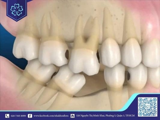 Ghép xương Implant khi bị tiêu xương hàm