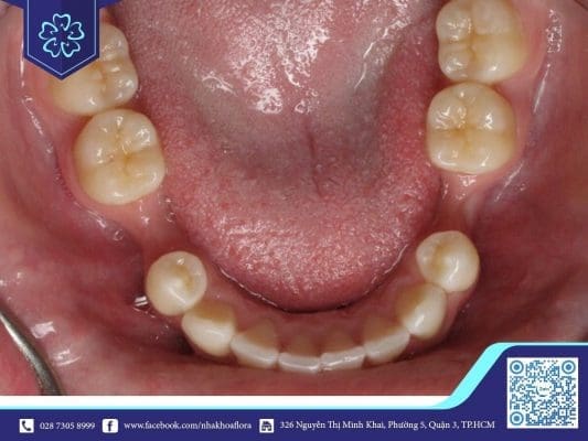 Mất răng lâu năm xuất hiện tình trạng tiêu xương (ảnh minh họa) Mất răng lâu năm xuất hiện tình trạng tiêu xương (ảnh minh họa)