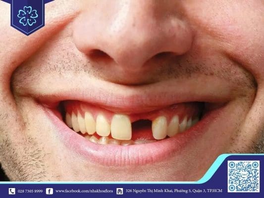 Mất răng lâu năm có trồng răng được không? (ảnh minh họa) Mất răng lâu năm có trồng răng được không? (ảnh minh họa)
