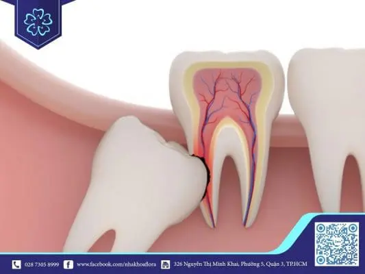 Tìm hiểu tất tần tật về răng số 8 3
