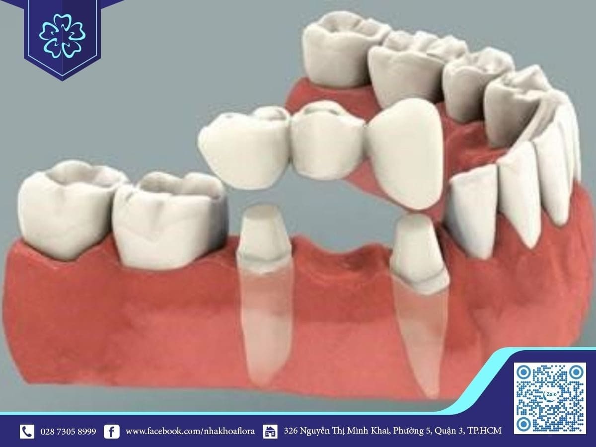 Cầu răng sứ Cầu răng sứ hay làm răng Implant