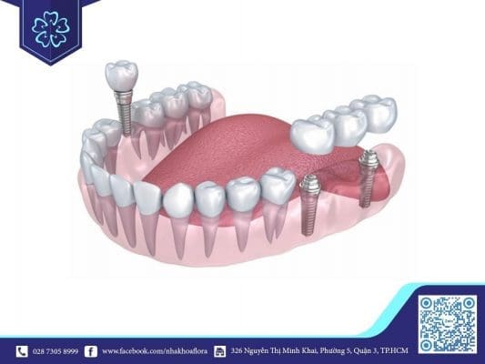 Hình ảnh mô phỏng trồng răng Implant