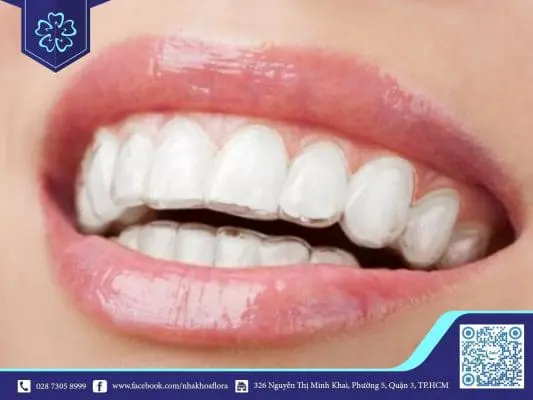 NIỀNG RĂNG THẨM MỸ GIÁ BAO NHIÊU? NÊN CHỌN CÁCH NIỀNG RĂNG NÀO? 3