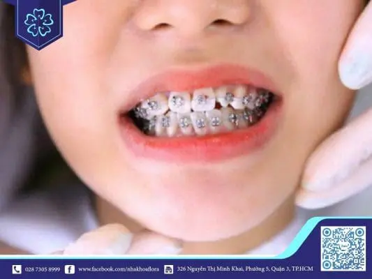 CÁC BIẾN CHỨNG THƯỜNG GẶP KHI NIỀNG RĂNG KÉM CHẤT LƯỢNG. 2