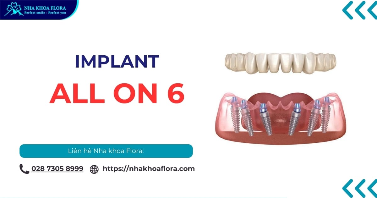 Trồng răng Implant All on 6 có tốt không? Giá bao nhiêu?