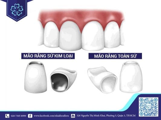 Răng sứ kim loại có tuổi thọ kém hơn răng sứ toàn sứ