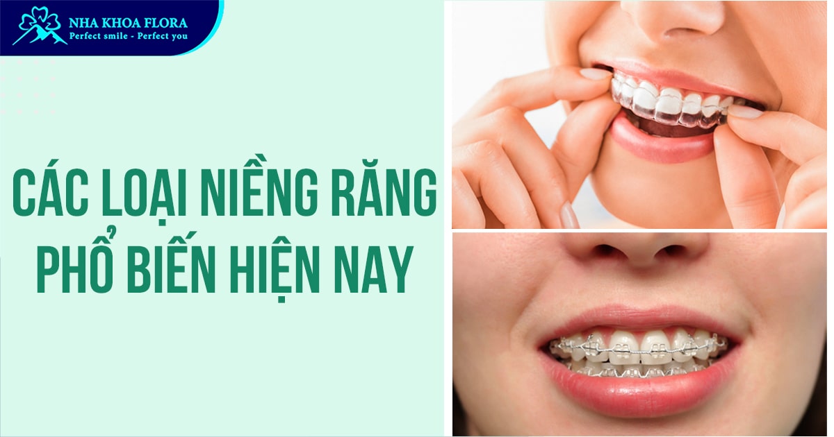 Các loại niềng răng phổ biến? Ưu và nhược điểm chi tiết