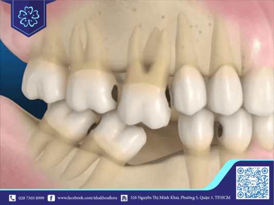 rang-bi-xo-lech Răng xô lệch gây mất thẩm mỹ và ảnh hưởng chức năng ăn nhai (ảnh minh họa)