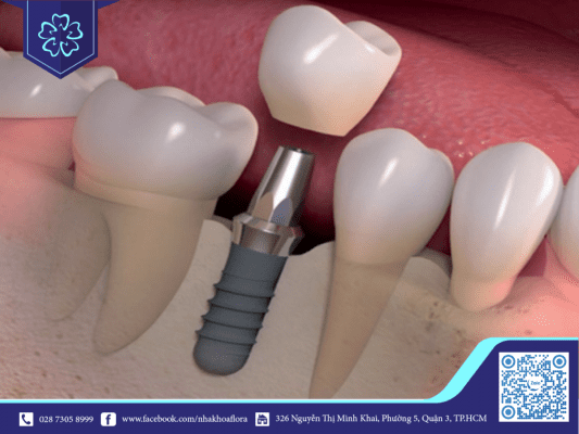 Trụ Implant Thụy Sĩ là vật liệu tốt nhất hiện nay, chỉ sau chân răng thật của bạn (ảnh minh họa) Trụ Implant Thụy Sĩ là vật liệu tốt nhất hiện nay, chỉ sau chân răng thật của bạn (ảnh minh họa)