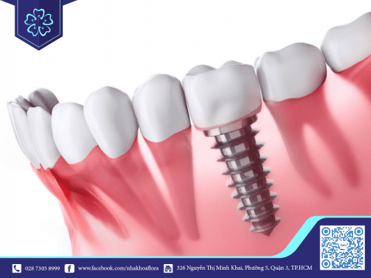 phuong-phap-cay-ghep-implant Cấy ghép Implant - Phương pháp phục hổi răng bị mất hiệu quả