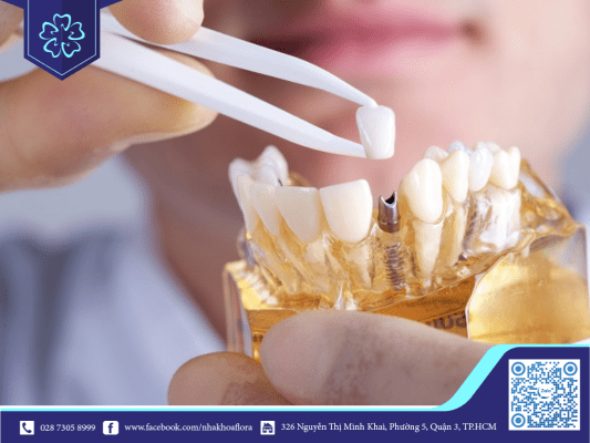 cay-ghep-rang-implant Cấy ghép răng Implant (ảnh minh họa)