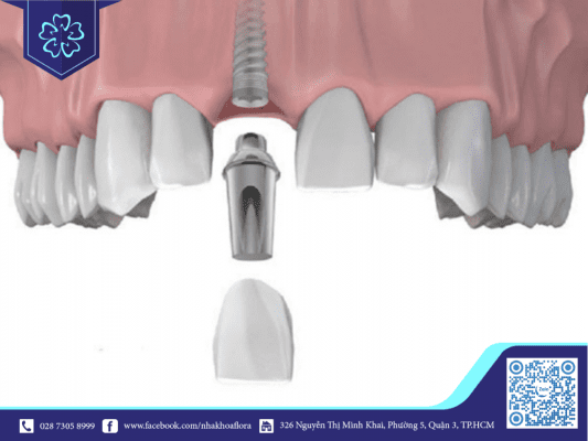 Trụ Implant tích hợp nhanh với xương hàm, rút ngắn quá trình trồng răng Implant lại không gây đau đớn (ảnh minh họa) Trụ Implant tích hợp nhanh với xương hàm, rút ngắn quá trình trồng răng Implant lại không gây đau đớn (ảnh minh họa)