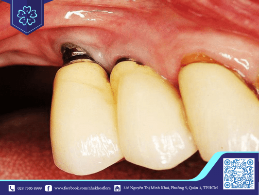 viêm quanh trụ implant - biến chứng sau trồng răng implant